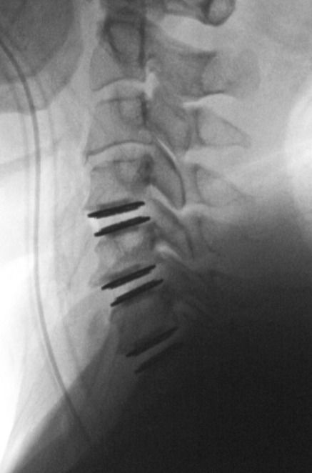 لأول‭ ‬مرة‭ ‬في‭ ‬المنطقة.. ‭ ‬إجراء‭ ‬أول‭ ‬عملية‭ ‬‭" ‬استبدال‭ ‬القرص‭ ‬الاصطناعي  للرقبة‭ ‬على‭ ‬ثالثة‭ ‬مستويات‭ ‬‭"  ‬في‭ ‬مستشفى‭ "‬ذا‭ ‬فيو‭"‬‭ ‬بالتعاون‭  ‬مع  Cedars-Sinai‭ ‬الأمريكية‭ ‬الطبية‭ ‬