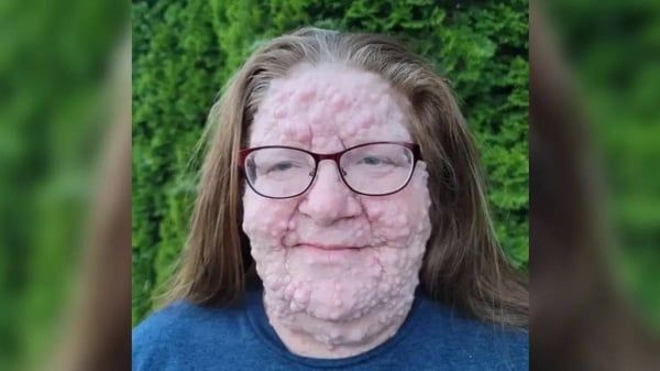 شكلها كاد يدمرها.. مصابة بمرض قلب وجهها إلى "فقاعات"