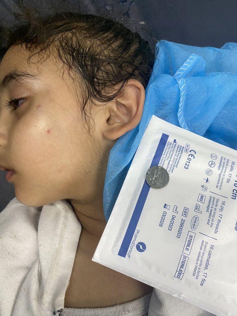 الجوع يفتك بغزة .. طبيب عماني ينقذ طفلة أكلت بطارية صغيرة