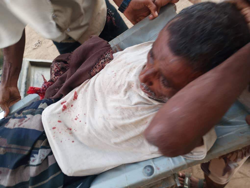 الحديدة.. شظايا قذيفة حوثية تودي بـ"بتر" يد مواطن في مديرية حيس 