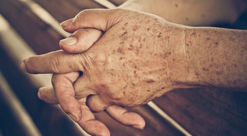 تحذيرات من مشكلة جلدية منتشرة عند كبار السن في السعودية هذه الأيام وطريقة حلها بالشكل الصحيح