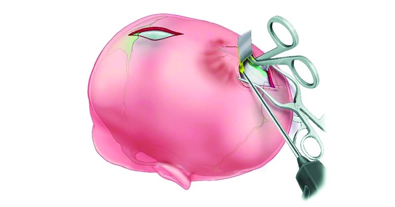 خدمة طبية جديدة بمستشفى جابر لتصحيح تشوهات الجمجمة لدى الأطفال